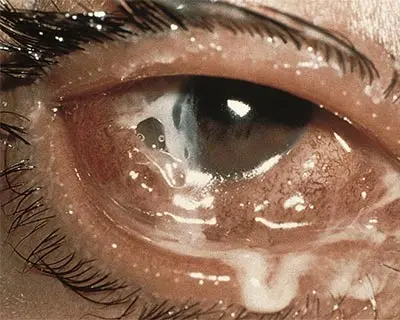 Bacterial Conjunctivitis eye 